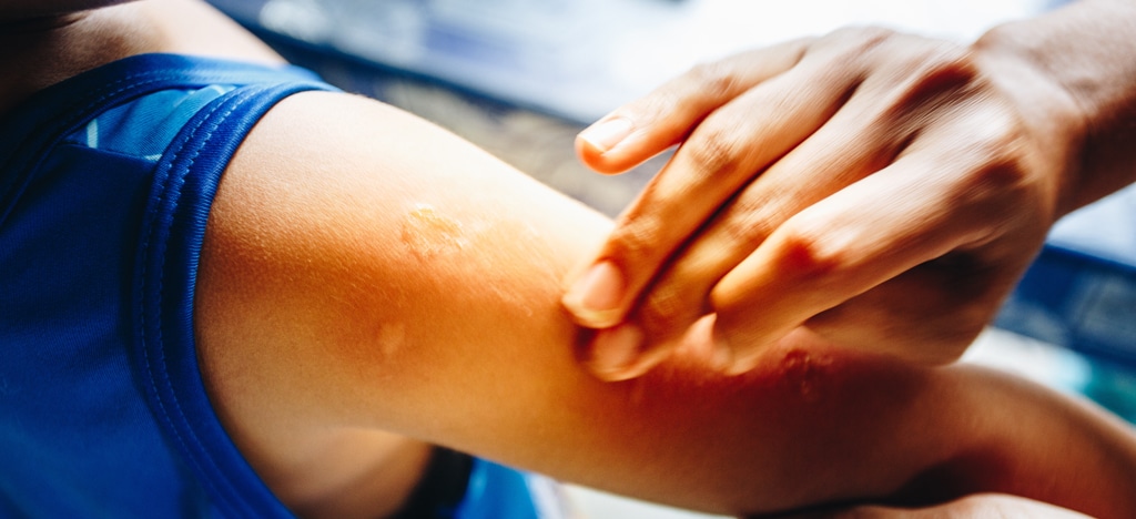 man looking at infected bite on his arm