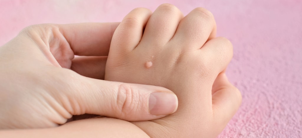 wart on foot in child)
